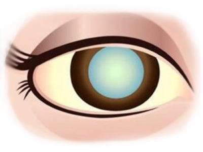 Cataract-1