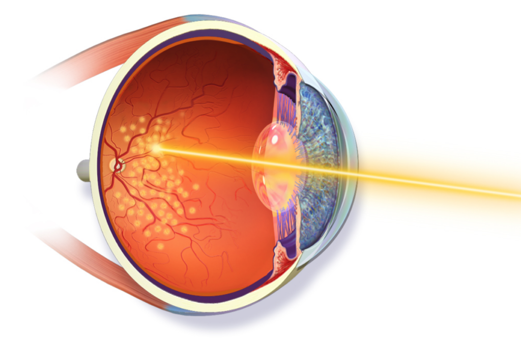 Retinal laser yandex