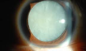 Best Cataract Treatment in Santacruz and Vileparle​