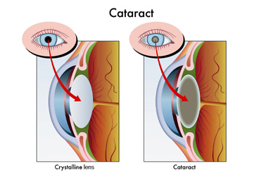 cataract-thumb (1)