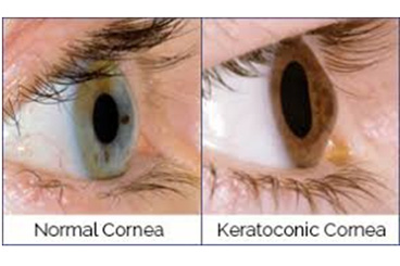 corneal-diseases-thumb