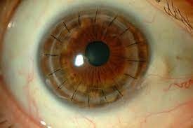 Corneal Transplant Surgery