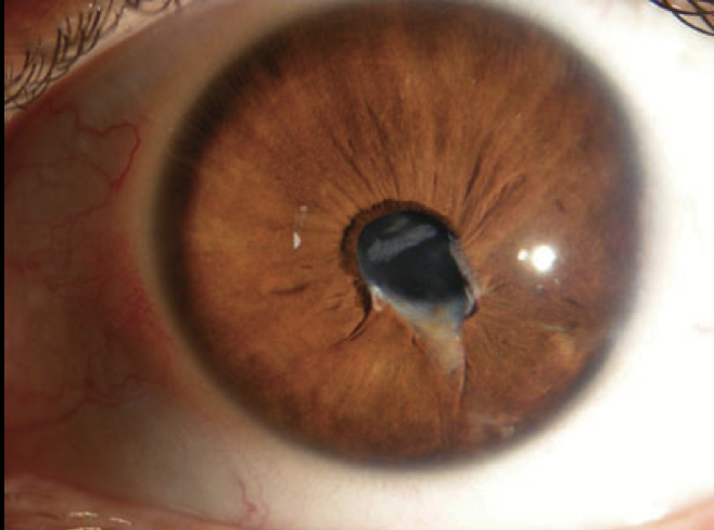 Traumatic Cataract yandex