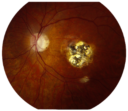 Uveitis