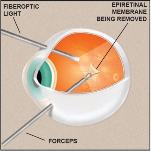 Retinal Surgery