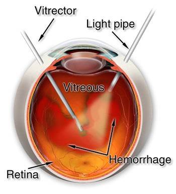 Vitrectomy yandex