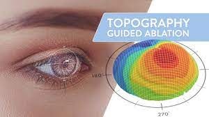WhatsApp Image 2023-08-08 at 13.57.42Topography-guided photorefractive keratectomy