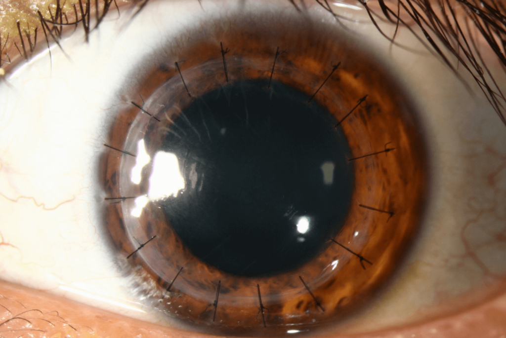 corneal transplant (1)