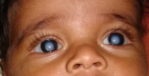 pediatric RETINOBLASTOMA