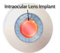 Intraocular lens implant