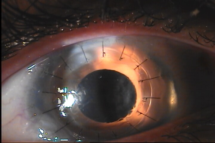 CORNEA