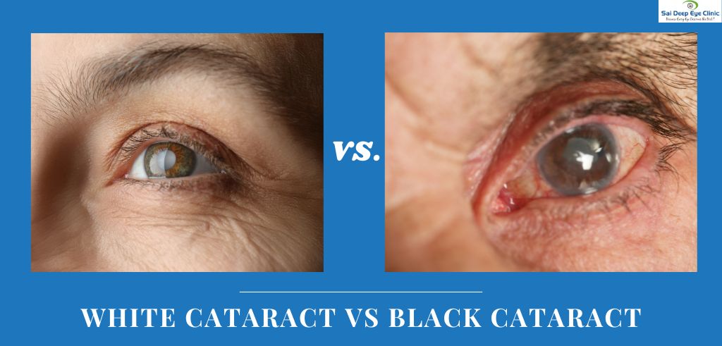 white cataract vs black cataract
